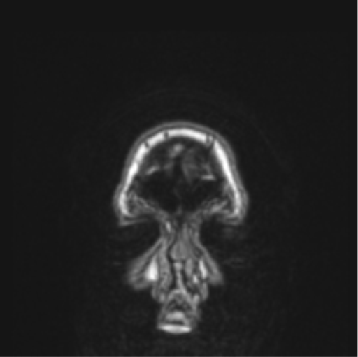 File:Cerebral abscess from pulmonary arteriovenous malformation (Radiopaedia 86275-102291 Coronal T1 87).png