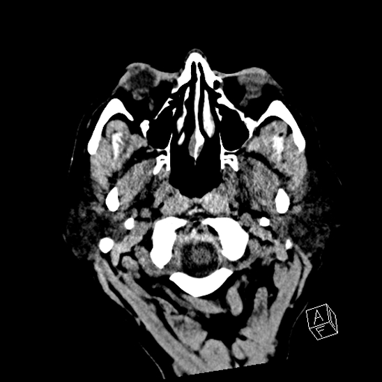 Cerebral abscess with ventriculitis (Radiopaedia 78965-91876 Axial non-contrast 4).jpg