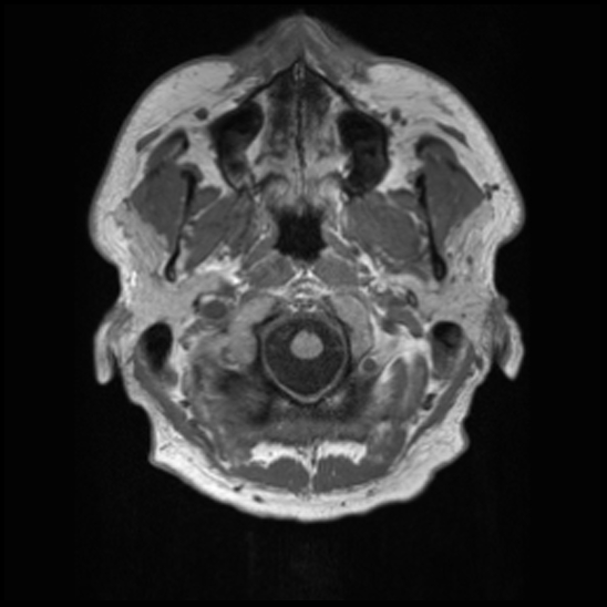 File:Cerebral abscess with ventriculitis (Radiopaedia 78965-91878 Axial T1 2).jpg