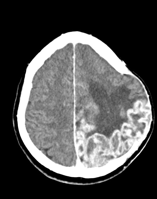 Cerebral abscesses (Radiopaedia 70458-80568 Axial Contrast 46).jpg