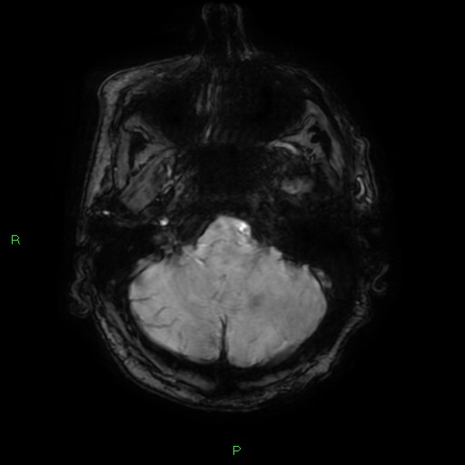 File:Cerebral amyloid angiopathy-associated lobar intracerebral hemorrhage (Radiopaedia 58376-65512 Axial SWI 10).jpg