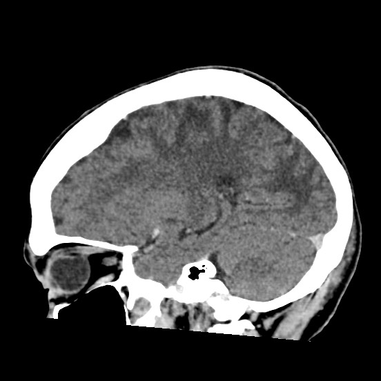 Cerebral amyloid angiopathy-related inflammation (Radiopaedia 74836-85848 C 40).jpg