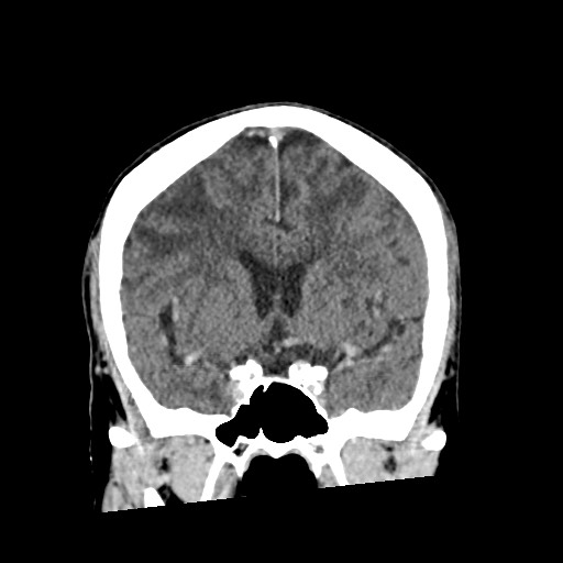 Cerebral amyloid angiopathy-related inflammation (Radiopaedia 74836-85848 Coronal non-contrast 30).jpg