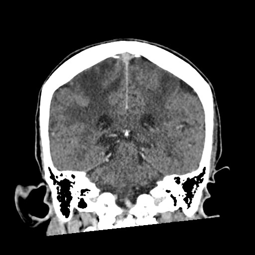 Cerebral amyloid angiopathy-related inflammation (Radiopaedia 74836-85848 Coronal non-contrast 45).jpg