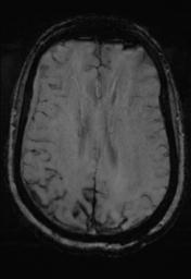 File:Cerebral amyloid angiopathy (Radiopaedia 29129-29518 Axial SWI MPR 23).jpg