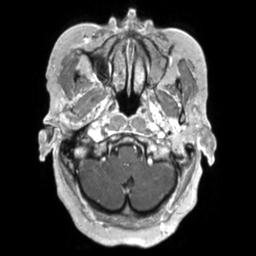 Cerebral amyloid angiopathy (Radiopaedia 29129-29518 Axial T1 C+ 24).jpg