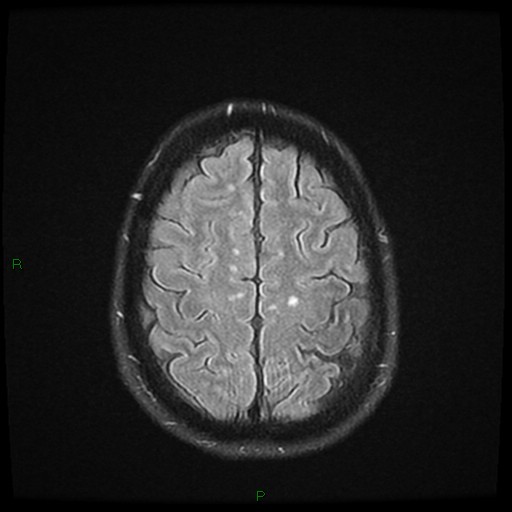 File:Cerebral amyloid angiopathy (Radiopaedia 77506-89664 Axial FLAIR 23).jpg