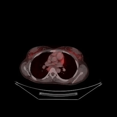 Cerebral and abdominal tuberculosis (Radiopaedia 90499-107853 C 100).jpg
