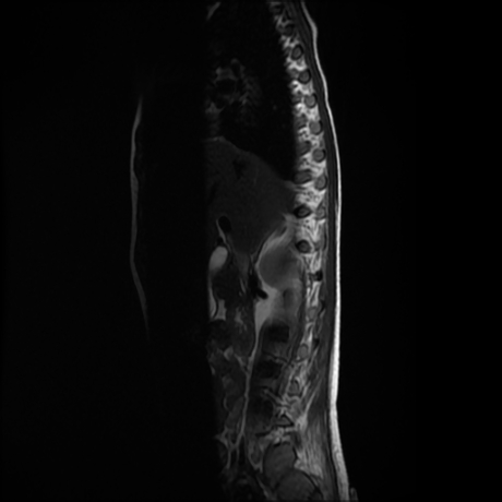 File:Cerebral and spinal tuberculosis (Radiopaedia 90489-107912 Sagittal T2 11).jpg