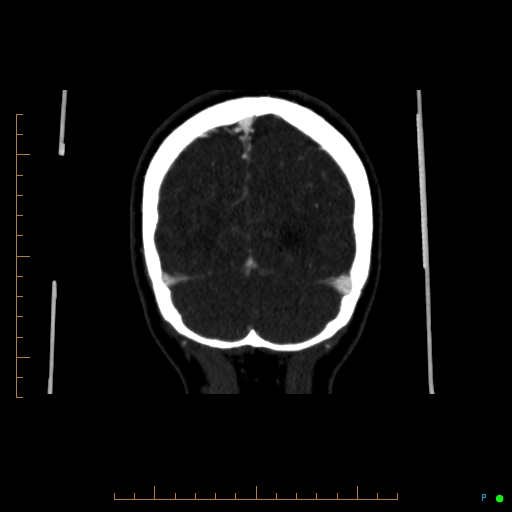 Cerebral arteriovenous malformation (AVM) (Radiopaedia 78162-90706 Coronal CTA 21).jpg