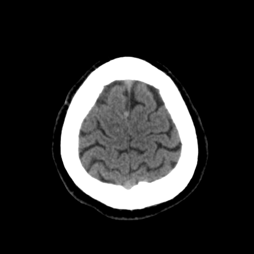 File:Cerebral arteriovenous malformation (Radiopaedia 39259-41505 Brain Ax 5mm 25).png