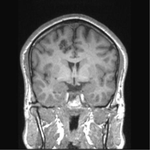 Cerebral arteriovenous malformation (Radiopaedia 39259-41506 Coronal T1 54).png