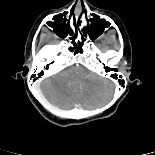 Cerebral arteriovenous malformation (Radiopaedia 73830-84645 B 78).jpg