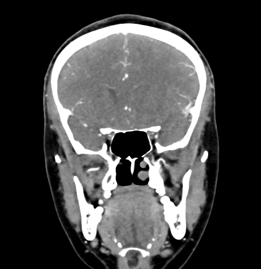 Cerebral arteriovenous malformation (Radiopaedia 73830-84645 C 34).jpg