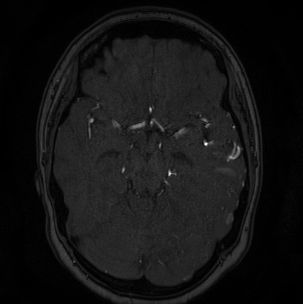 Cerebral arteriovenous malformation (Radiopaedia 74411-85654 Axial MRA 51).jpg