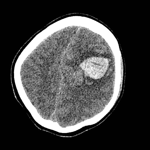 Cerebral arteriovenous malformation (Radiopaedia 79677-92887 Axial non-contrast 30).jpg