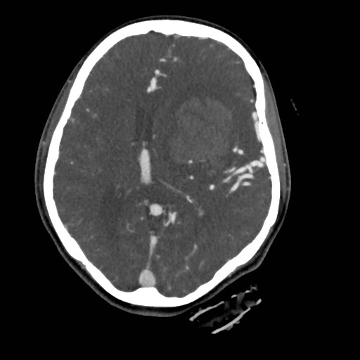 File:Cerebral arteriovenous malformation (Radiopaedia 79677-92888 A 29).jpg