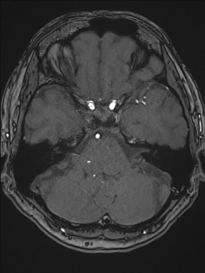 File:Cerebral arteriovenous malformation (Radiopaedia 84015-99245 Axial TOF 83).jpg