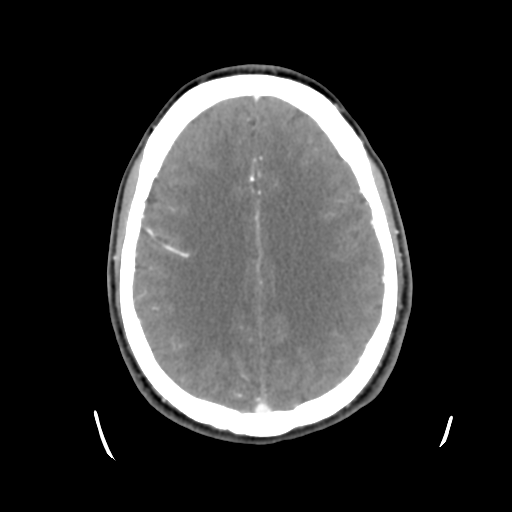 Cerebral arteriovenous malformation (Spetzler-Martin grade 2) (Radiopaedia 41262-44076 Axial C+ 35).png