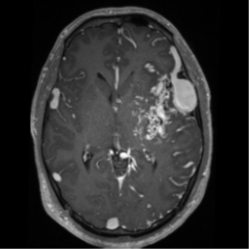 File:Cerebral arteriovenous malformation - huge (Radiopaedia 35734-37272 Axial T1 C+ 34).png