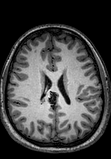 File:Cerebral arteriovenous malformation at posterior body of corpus callosum (Radiopaedia 74111-84925 Axial T1 104).jpg