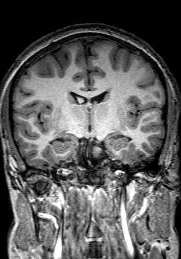 File:Cerebral arteriovenous malformation at posterior body of corpus callosum (Radiopaedia 74111-84925 Coronal T1 159).jpg