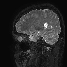 Cerebral arteriovenous malformation at posterior body of corpus callosum (Radiopaedia 74111-84925 Sagittal T2 93).jpg