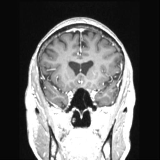 Cerebral arteriovenous malformation with hemorrhage (Radiopaedia 34422-35737 Coronal T1 C+ 62).png