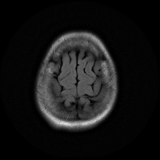 File:Cerebral autosomal dominant arteriopathy with subcortical infarcts and leukoencephalopathy (CADASIL) (Radiopaedia 41018-43763 Ax T2 Flair PROP 18).png