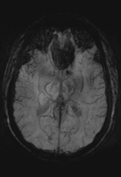 File:Cerebral cavernoma and development venous anomaly (Radiopaedia 37603-39482 Axial SWI MIP 17).png