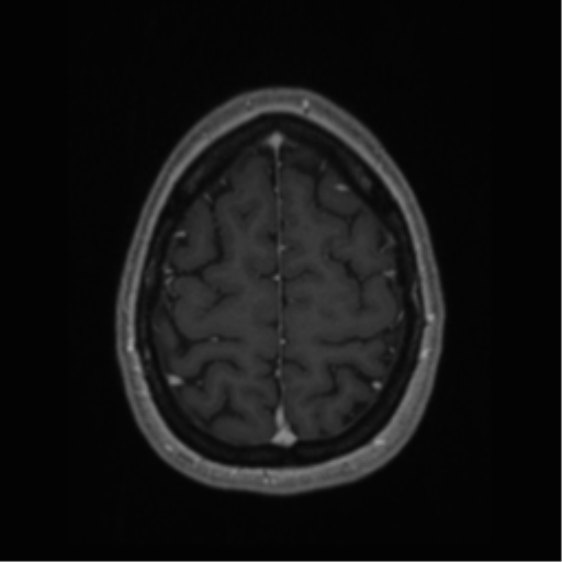 Cerebral cavernoma and development venous anomaly (Radiopaedia 37603-39482 Axial T1 C+ 64).png