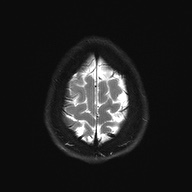 Cerebral cavernous venous malformation (Radiopaedia 70008-80021 Axial DWI 28).jpg