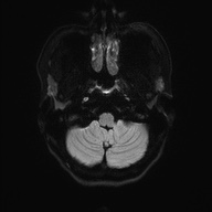 Cerebral cavernous venous malformation (Radiopaedia 70008-80021 Axial DWI 34).jpg