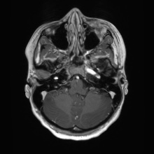 Cerebral cavernous venous malformation (Radiopaedia 70008-80021 Axial T1 C+ 13).jpg