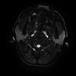 Cerebral cavernous venous malformation (Zabramski type II) (Radiopaedia 85511-101198 Axial DWI 1).jpg
