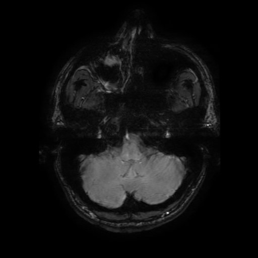 File:Cerebral cavernous venous malformation (Zabramski type II) (Radiopaedia 85511-101198 Axial SWI 24).jpg