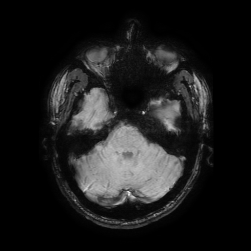 Cerebral cavernous venous malformation (Zabramski type II) (Radiopaedia 85511-101198 Axial SWI 42).jpg