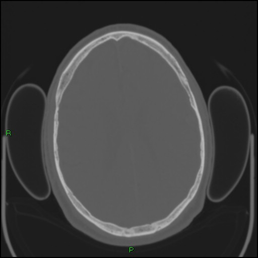 Cerebral contusions (Radiopaedia 33868-35039 Axial bone window 139).jpg