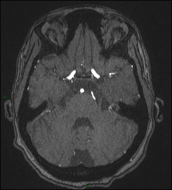Cerebral fat embolism (Radiopaedia 35022-36525 Axial TOF 59).jpg