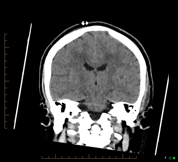 Cerebral fat embolism (Radiopaedia 85521-101220 Coronal non-contrast 36).jpg