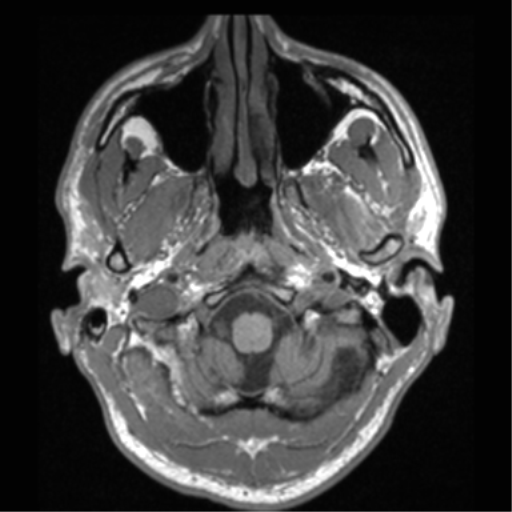 Cerebral hemorrhagic contusions- temporal evolution (Radiopaedia 40224-42757 Axial T1 10).png