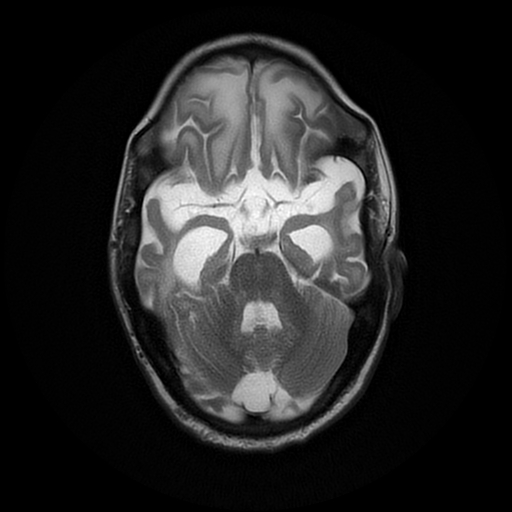 File:Cerebral manifestations of mucopolysaccharidosis type I (Radiopaedia 59171-66487 Axial T2 7).jpg