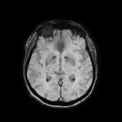Cerebral metastases - melanoma (Radiopaedia 80972-94522 Axial SWI 49).jpg