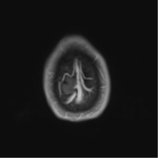 Cerebral metastasis - melanoma (Radiopaedia 54718-60954 Axial T1 C+ fat sat 49).png