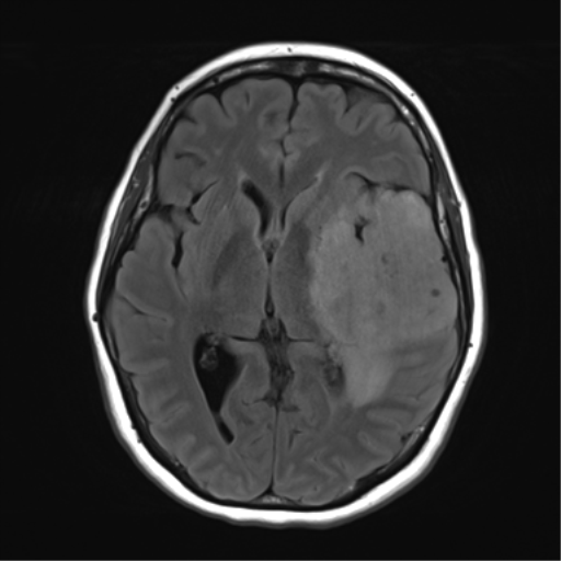 File:Cerebral metastasis mimicking glioblastoma (Radiopaedia 69155-78937 Axial FLAIR 17).png