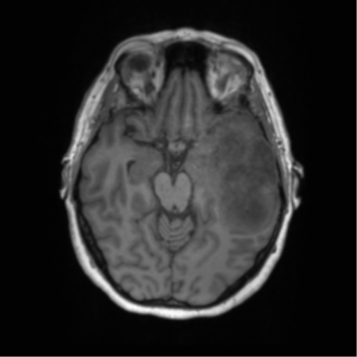 Cerebral metastasis mimicking glioblastoma (Radiopaedia 69155-78937 Axial T1 22).png