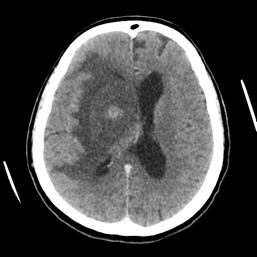 Cerebral metastasis to basal ganglia (Radiopaedia 81568-95412 Axial C+ delayed 35).png
