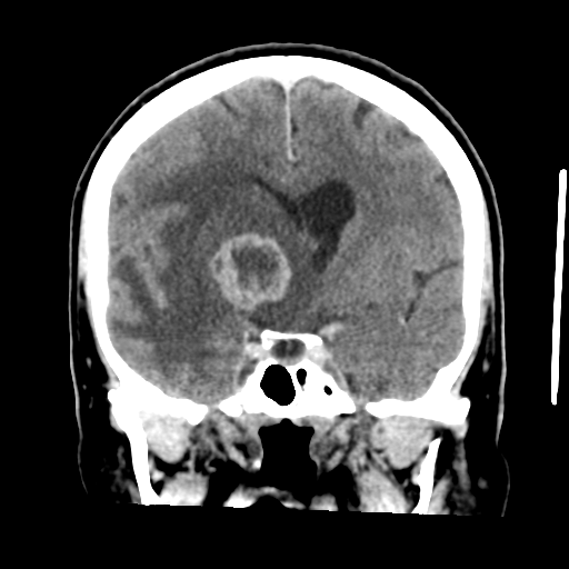 Cerebral metastasis to basal ganglia (Radiopaedia 81568-95412 Coronal C+ delayed 29).png