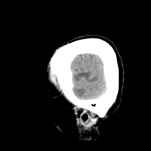 Cerebral metastasis to basal ganglia (Radiopaedia 81568-95412 Sagittal C+ delayed 8).png
