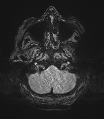 Cerebral metastasis to basal ganglia (Radiopaedia 81568-95413 Axial SWI magnitude 9).png
